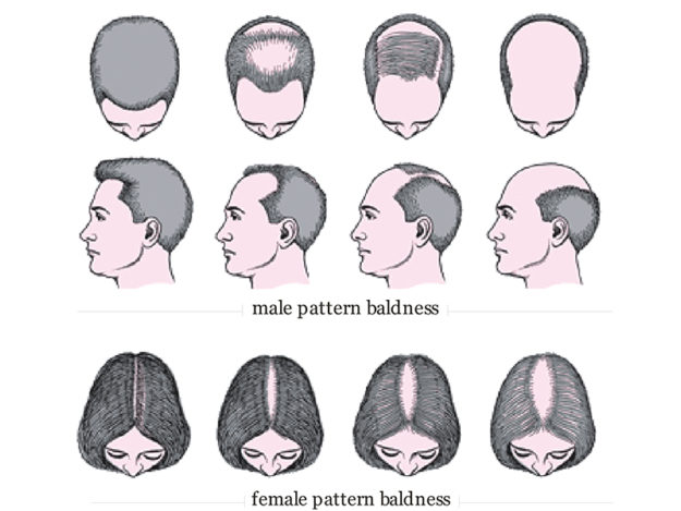 Zinsel Hair Loss