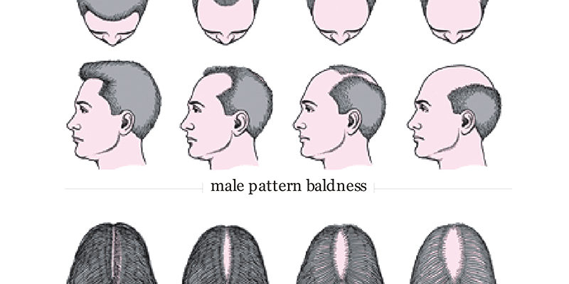 Hair loss Myths Blog Zinsel Hair Loss